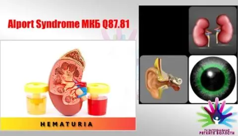 Ретки бубрежни болести: Алпортов синдром