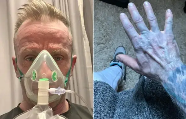 БРИТАНЕЦ ИТНО ОДНЕСЕН ВО БОЛНИЦА ОТКАКО СЕ РАЗБУДИЛ СО МОДРА КОЖА, ИЗЛЕГЛО ДЕКА НЕ ЈА ИСПРАЛ НОВАТА ПОСТЕЛНИНА