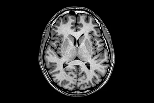 Откриено ново генетско нарушување, може да објасни илјадници случаи