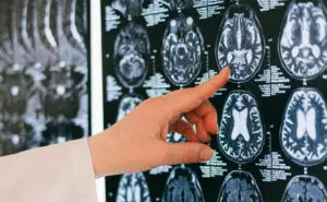 Револуционерните лекови против Алцхајмерова болест вредни 90.000 фунти веројатно нема да имаат корист кај пациентите