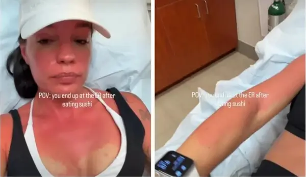 По еден залак од ова популарно јадење, на кожата добила црвенило: Може да биде опасно ако не се складира правило во организамот