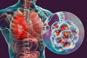 Во Њујорк регистрирани 14 случаи на заразени со легионарска болест