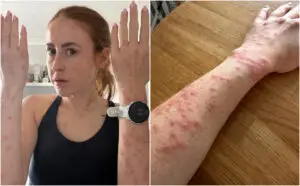 ФОТО | Престојувала една ноќ во британски хотел и се разбудила со повеќе од 100 каснувања од креветни бубачки: „Никој не ми помогна“