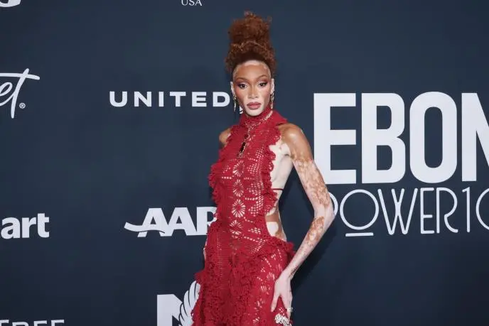 Децата ја нарекувале „крава“ и „зебра“- сега прошета по црвениот тепих во фустан направен за нејзината посебност (ФОТО)