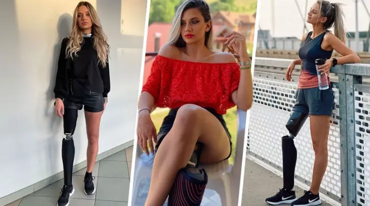 Марија ја загуби ногата на 16 години, а денес е модел: Паднав и го повредив коленото, но отокот не ми помина