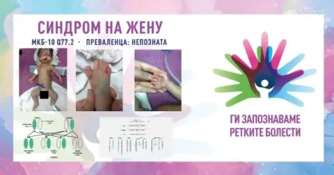 „Ги запознаваме ретките болести“: Синдром на жену