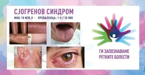 Ги запознаваме ретките болести: Сјогренов синдром