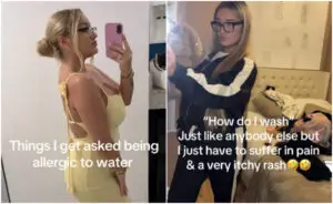 Девојка е алергична на вода веќе 10 години: „Мислат дека лажам и дека не се туширам“